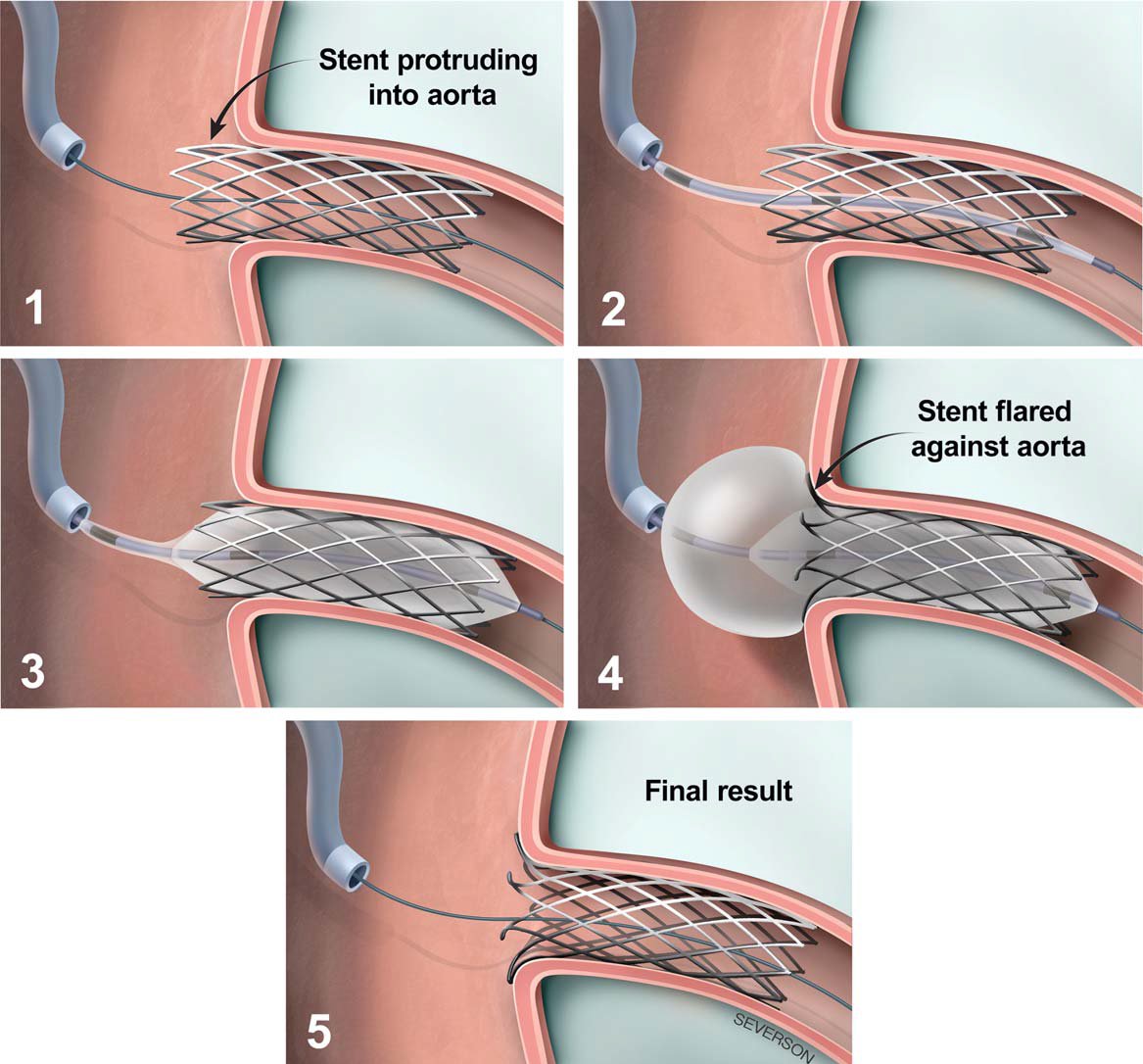 Journal of Invasive Cardiology (@invasivecardiol) on Twitter photo May Original Research: Use of the Ostial Flash Balloon in Aorto-Ostial #CTO #PCI ➡️ hubs.ly/Q03nRJDx0
<a href="/dnzmtlu/">Deniz Mutlu</a> <a href="/CCAD_MHIF/">Center for Coronary Artery Disease</a> <a href="/LAzzaliniMD/">Lorenzo Azzalini</a> <a href="/yadersandoval/">Yader Sandoval</a> <a href="/esbrilakis/">Emmanouil Brilakis</a> <a href="/DLBHATTMD/">Dr. Deepak L. Bhatt</a> #cardioTwitter #cardioX #cardiology #interventionalcardiology May Original Research: Use of the Ostial Flash Balloon in Aorto-Ostial #CTO #PCI ➡️ hubs.ly/Q03nRJDx0
<a href="/dnzmtlu/">Deniz Mutlu</a> <a href="/CCAD_MHIF/">Center for Coronary Artery Disease</a> <a href="/LAzzaliniMD/">Lorenzo Azzalini</a> <a href="/yadersandoval/">Yader Sandoval</a> <a href="/esbrilakis/">Emmanouil Brilakis</a> <a href="/DLBHATTMD/">Dr. Deepak L. Bhatt</a> #cardioTwitter #cardioX #cardiology #interventionalcardiology
