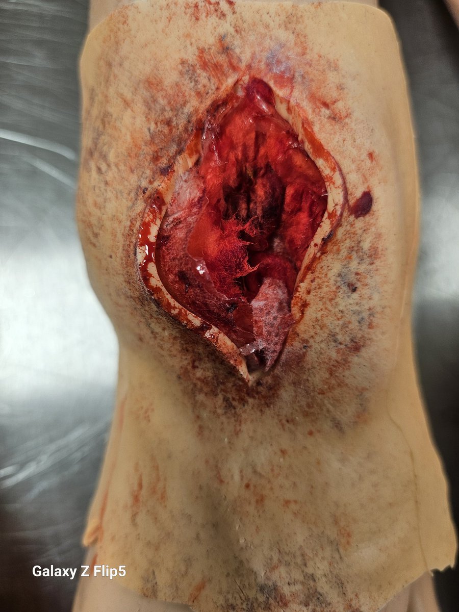 Caz (RSciTech ASPiH - C S & Sim Tech CHFT) (@cazandal) on Twitter photo ATLS <a href="/CHFTNHS/">Calderdale and Huddersfield NHS Foundation Trust</a> <a href="/ChftmedicalE/">CHFT Medical Education</a> Learning Centre today, resus team asked if I could help out with some trauma limbs, to allow candidates to pack the wounds. Great feedback from the team, facuty & candidates. #HappySimTech #SimulationRocks #SimTechsRocks ATLS <a href="/CHFTNHS/">Calderdale and Huddersfield NHS Foundation Trust</a> <a href="/ChftmedicalE/">CHFT Medical Education</a> Learning Centre today, resus team asked if I could help out with some trauma limbs, to allow candidates to pack the wounds. Great feedback from the team, facuty & candidates. #HappySimTech #SimulationRocks #SimTechsRocks