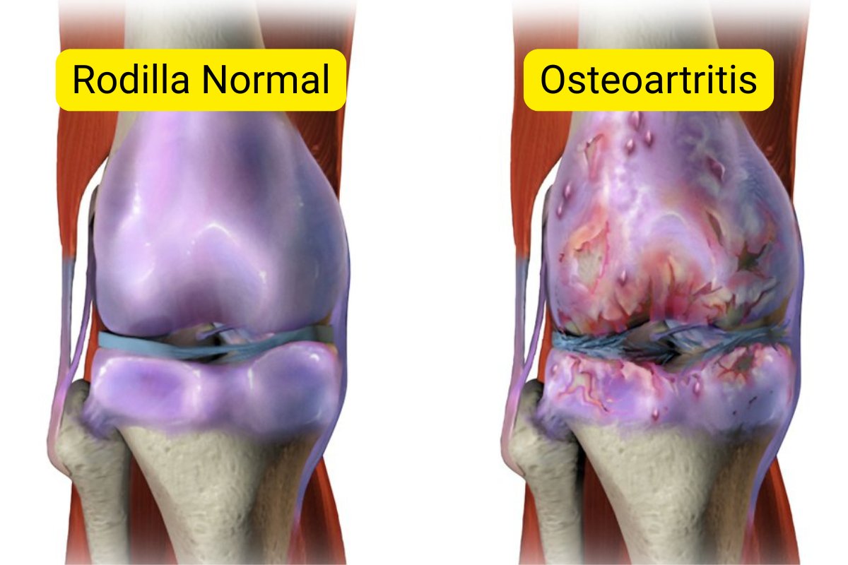 santi_despierta's tweet photo. El dolor articular no es porque te estás haciendo viejo. 

Es la inflamación enviándote señales: 

• Lo que comes te está envenenando. 
• No te estás recuperando bien. 
• Te mueves como si estuvieras oxidado. 

Aquí tienes todo lo que debes saber para cuidar tus articulaciones de forma natural: