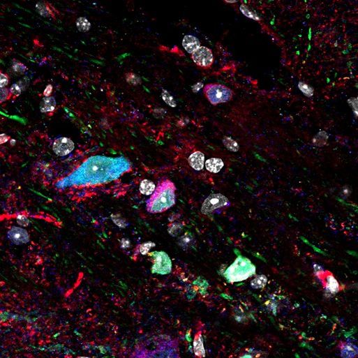 UK Dementia Research Institute (@ukdri) on Twitter photo New research by <a href="/marcaurelbusche/">Marc Aurel Busche</a> identifies where Alzheimer's begins in the brain, revealing which layers and cell types of the brain are first affected 🧠
The study opens up potential new pathways for targeted therapies👉buff.ly/4GlltQF New research by <a href="/marcaurelbusche/">Marc Aurel Busche</a> identifies where Alzheimer's begins in the brain, revealing which layers and cell types of the brain are first affected 🧠
The study opens up potential new pathways for targeted therapies👉buff.ly/4GlltQF