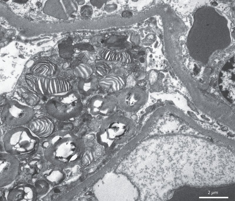 What is the #Lysosomal disease?
21 years old with painful neuropathy for 10 years and proteinuria.
EM of the Kidney showed #Zebra Bodies.
What is the diagnosis?
#MedTwitter #MedEd