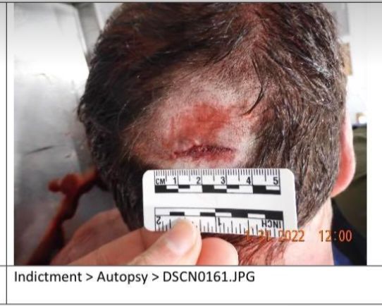 DoctorTurtleboy's tweet photo. Please explain to me how a flat, "frozen" lawn causes this 2 inch laceration to the back of John O'Keefe's head. This is from a blunt, lateral object, such as a stair, a weight bench, a bat, or a pipe. There is no way "frozen" grass would cause such a laceration. https://t.co/a5FEsHZQXE