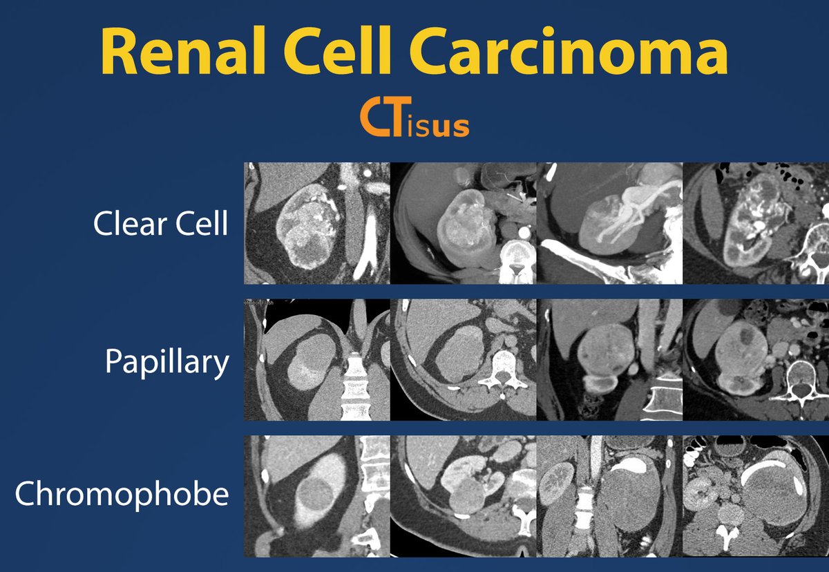 Renal Cell Carcinoma

Read more: ctisus.com/learning/featu…