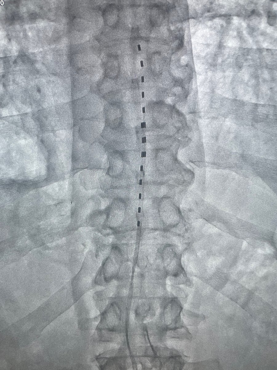 Big news! <a href="/alexheatonmd/">Alex Heaton, MD</a> performed our 1st #spinalcordstimulator placement for a patient suffering w/ painful diabetic #neuropathy &amp; it was a success! 🙌
Thrilled to announce we are offering this advanced therapy as part of a #painmedicine service line <a href="/VIRChicago/">VIR Chicago</a> <a href="/dougbeall/">Douglas Beall</a>