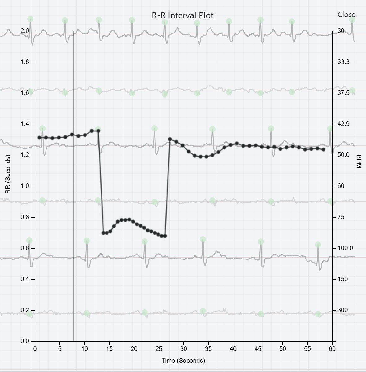 Rhythm Strip from <a href="/AliveCor/">AliveCor</a> Something you don't see every day. 2:1 second degree AVB with a short segment of 1:1 conduction.