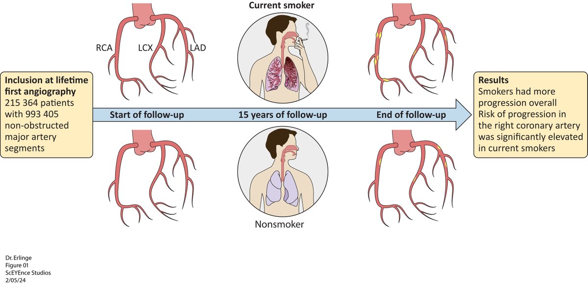 MyJSCAI (@myjscai) on Twitter photo 📖In over 215,000 pts from the #SCAAR & #WDHR registry, smoking was associated w progressive #CAD in #RCA, & smokers were more likely to receive #PCI vs RCA than #LAD when presenting with #STEMI 💡
Read more:
➡️doi.org/10.1016/j.jsca…
<a href="/FrobertOle/">Ole Fröbert</a> <a href="/GroThrane/">Pernille Gro Thrane</a> <a href="/GreggWStone/">Gregg W. Stone MD</a> 📖In over 215,000 pts from the #SCAAR & #WDHR registry, smoking was associated w progressive #CAD in #RCA, & smokers were more likely to receive #PCI vs RCA than #LAD when presenting with #STEMI 💡
Read more:
➡️doi.org/10.1016/j.jsca…
<a href="/FrobertOle/">Ole Fröbert</a> <a href="/GroThrane/">Pernille Gro Thrane</a> <a href="/GreggWStone/">Gregg W. Stone MD</a>