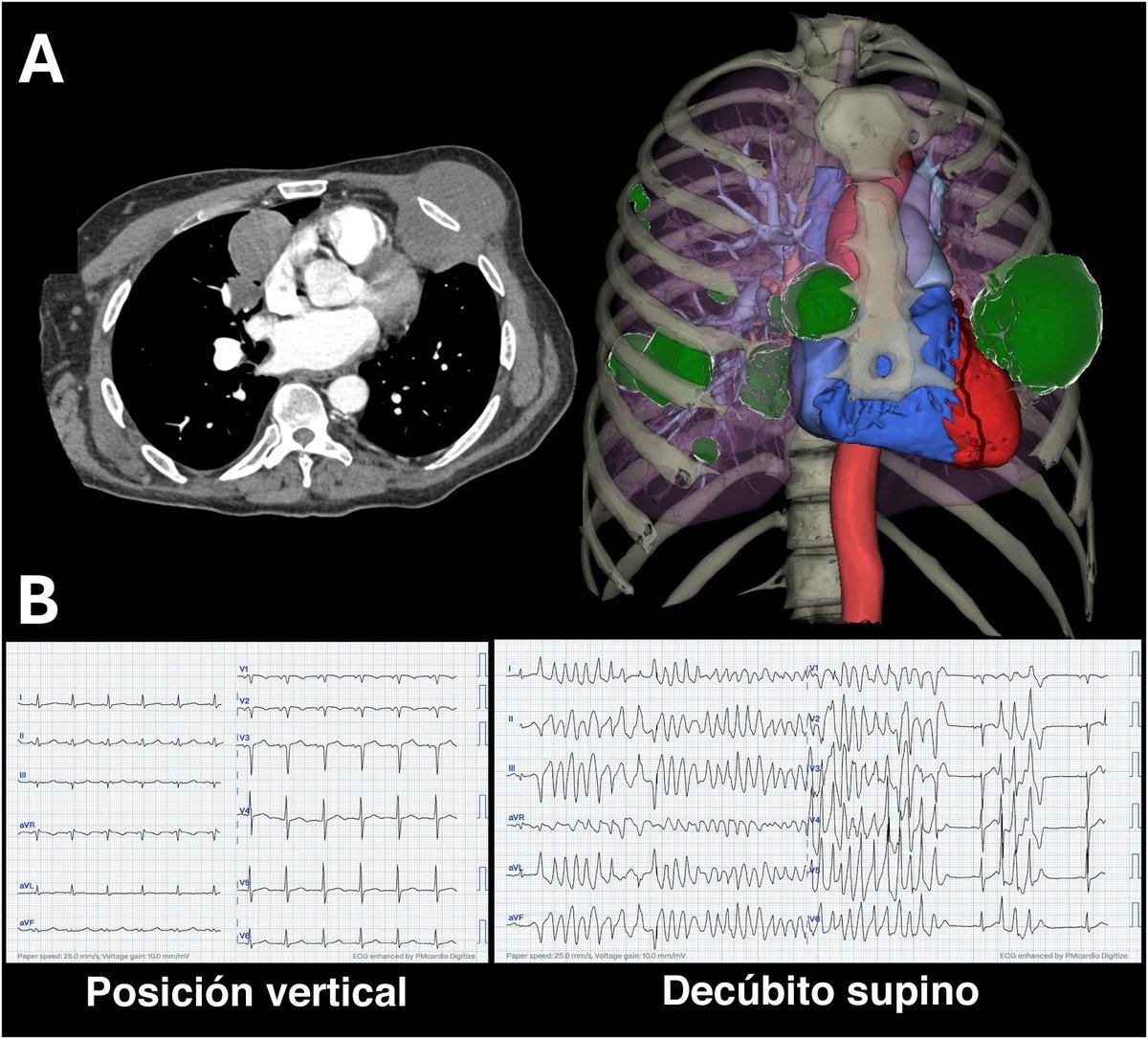 REC Publications (@revespcardiol) on Twitter photo Postural electrical storm: a rare consequence of a metastatic rhabdomyosarcoma #REC <a href="/MartinsRaphae15/">Raphael Martins</a>. revespcardiol.org/en-postural-el… Postural electrical storm: a rare consequence of a metastatic rhabdomyosarcoma #REC <a href="/MartinsRaphae15/">Raphael Martins</a>. revespcardiol.org/en-postural-el…
