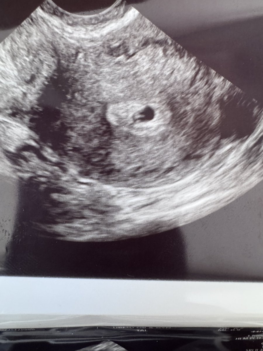 As many of you know, Daniel and I have tried to get pregnant for years. We got pregnant around Easter 2025

The early hormonal tests haven’t been promising, and the doctor says the odds aren’t in our favor. 

But today we saw the heartbeat. 

Please pray for this little one.