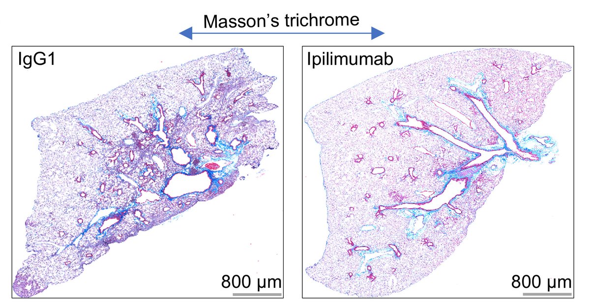 Journal of Clinical Investigation (@jclinicalinvest) on Twitter photo Promoting regenerative responses in a pulmonary fibrosis model!
Victor J. Thannickal & team <a href="/TulaneMedicine/">Tulane Medicine</a> discover blocking CTLA4 in immune cells induced regeneration and reduce fibrosis in a mouse model of idiopathic pulmonary fibrosis:
jci.org/articles/view/… Promoting regenerative responses in a pulmonary fibrosis model!
Victor J. Thannickal & team <a href="/TulaneMedicine/">Tulane Medicine</a> discover blocking CTLA4 in immune cells induced regeneration and reduce fibrosis in a mouse model of idiopathic pulmonary fibrosis:
jci.org/articles/view/…