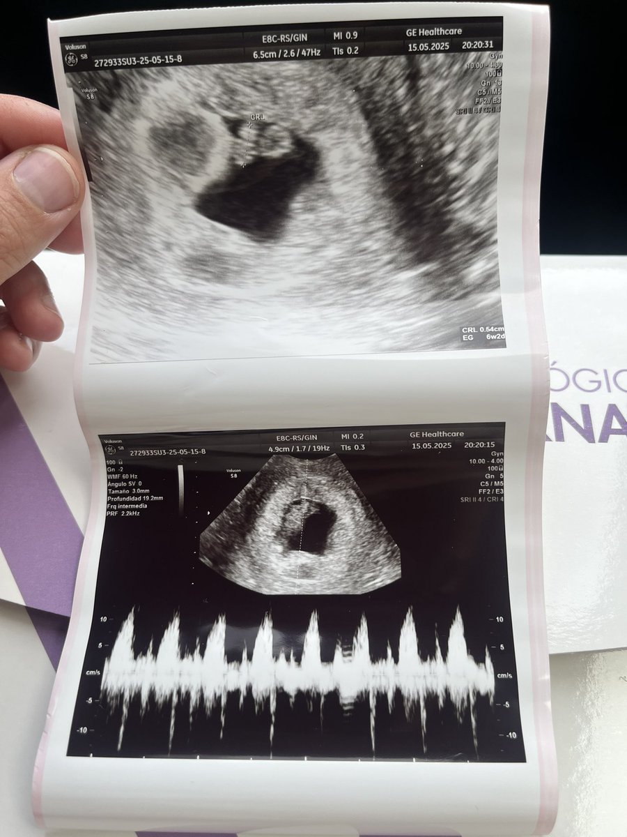 La 1a eco ha sido un momento muy intenso y bonito, cómo he llorado al escuchar el latido. No se puede describir con palabras después de tanto tiempo de sufrimiento. Todavía con cautela porque queda mucho por delante, pero permitiéndone ilusionarme y pasar a #infertilpreñis ❤️‍🩹