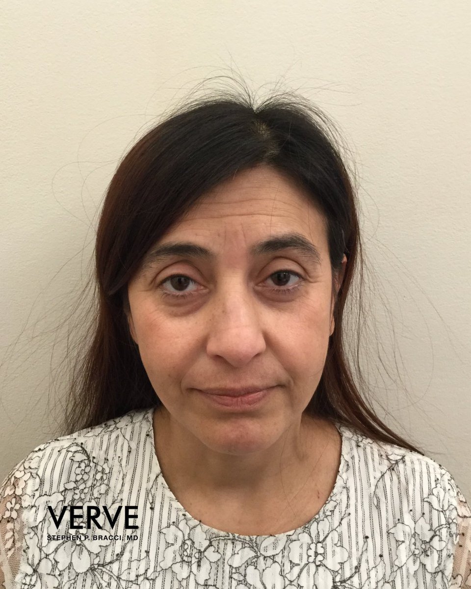 VerveCosmetics's tweet photo. Forehead lines and crow's feet? Not on our watch! Take control of your confidence and let Dr. Bracci rejuvenate your skin at any of our 5 studios.

What are you waiting for? Call us to make your personalized appointment with Dr. Bracci at (212) 888-3003. https://t.co/tGIoAampx8