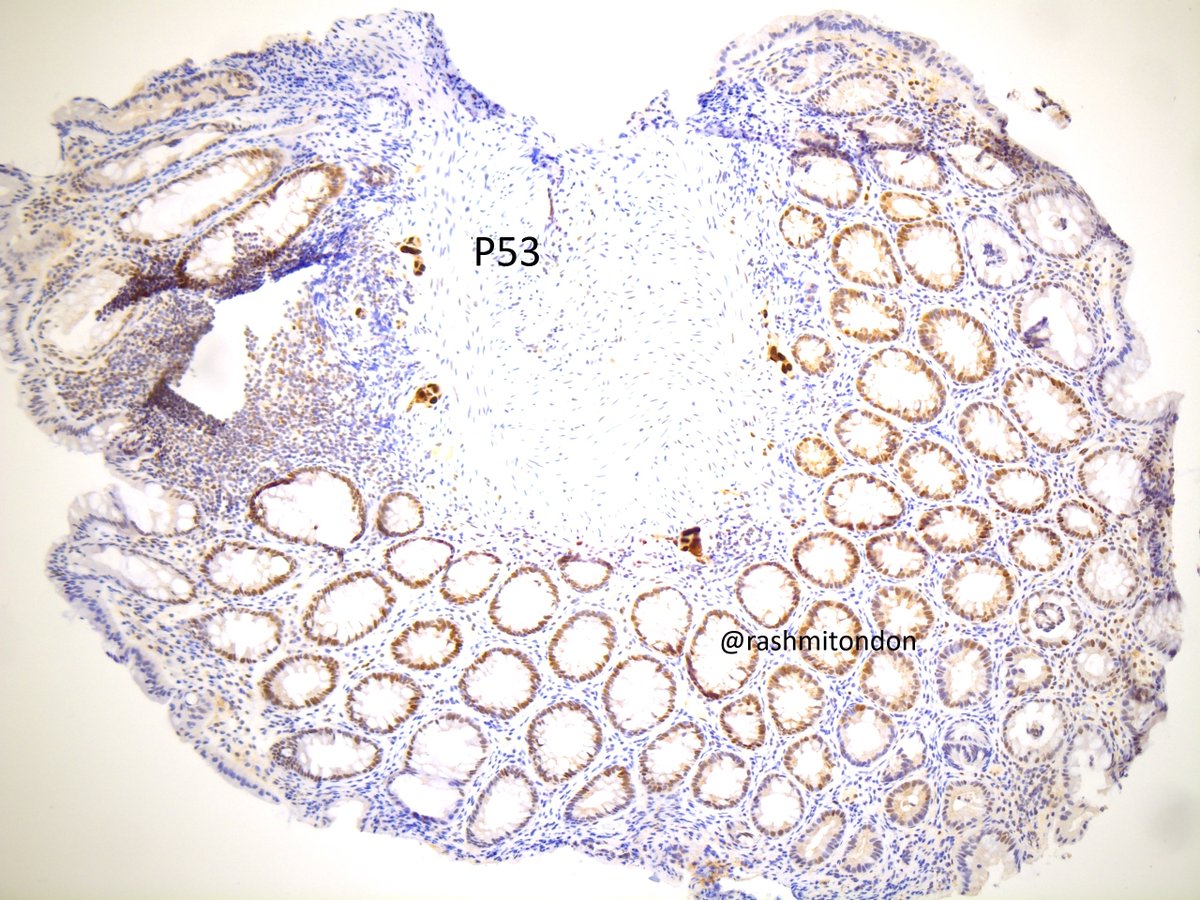 Rashmi Tondon (@rashmitondon) on Twitter photo Oh my!! Biopsy of a protuberance in sigmoid colon.
Don't forget to go on high power or do levels in a biopsy from lumps, bumps and humps.
HG serous carcinoma, + for PAX-8/P53 (images) and WT-1 (not shown). Most helpful stain: history
<a href="/PennPathLabMed/">Penn Path & Lab Medicine</a>
#pathology #PathTwitter Oh my!! Biopsy of a protuberance in sigmoid colon.
Don't forget to go on high power or do levels in a biopsy from lumps, bumps and humps.
HG serous carcinoma, + for PAX-8/P53 (images) and WT-1 (not shown). Most helpful stain: history
<a href="/PennPathLabMed/">Penn Path & Lab Medicine</a>
#pathology #PathTwitter