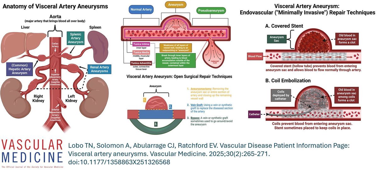 VascularMedicine (@vmj_svm) on Twitter photo Find our latest Vascular Disease Patient Information Page on Visceral Artery Aneurysms by <a href="/TabithaLobo/">Tabitha Lobo</a>, <a href="/PagingDrSolomon/">Alexandra Lauren</a>, Dr. Abularrage and <a href="/evratchford/">Elizabeth Ratchford</a>.
doi.org/10.1177/135886…
#Aneurysm Find our latest Vascular Disease Patient Information Page on Visceral Artery Aneurysms by <a href="/TabithaLobo/">Tabitha Lobo</a>, <a href="/PagingDrSolomon/">Alexandra Lauren</a>, Dr. Abularrage and <a href="/evratchford/">Elizabeth Ratchford</a>.
doi.org/10.1177/135886…
#Aneurysm