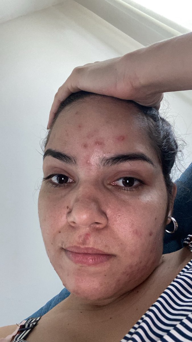Por dentro senti todos os efeitos colaterais possíveis que essa medicação causa, por fora a pele dos sonhos veio e autoestima foi totalmente renovada! #isotretinoína