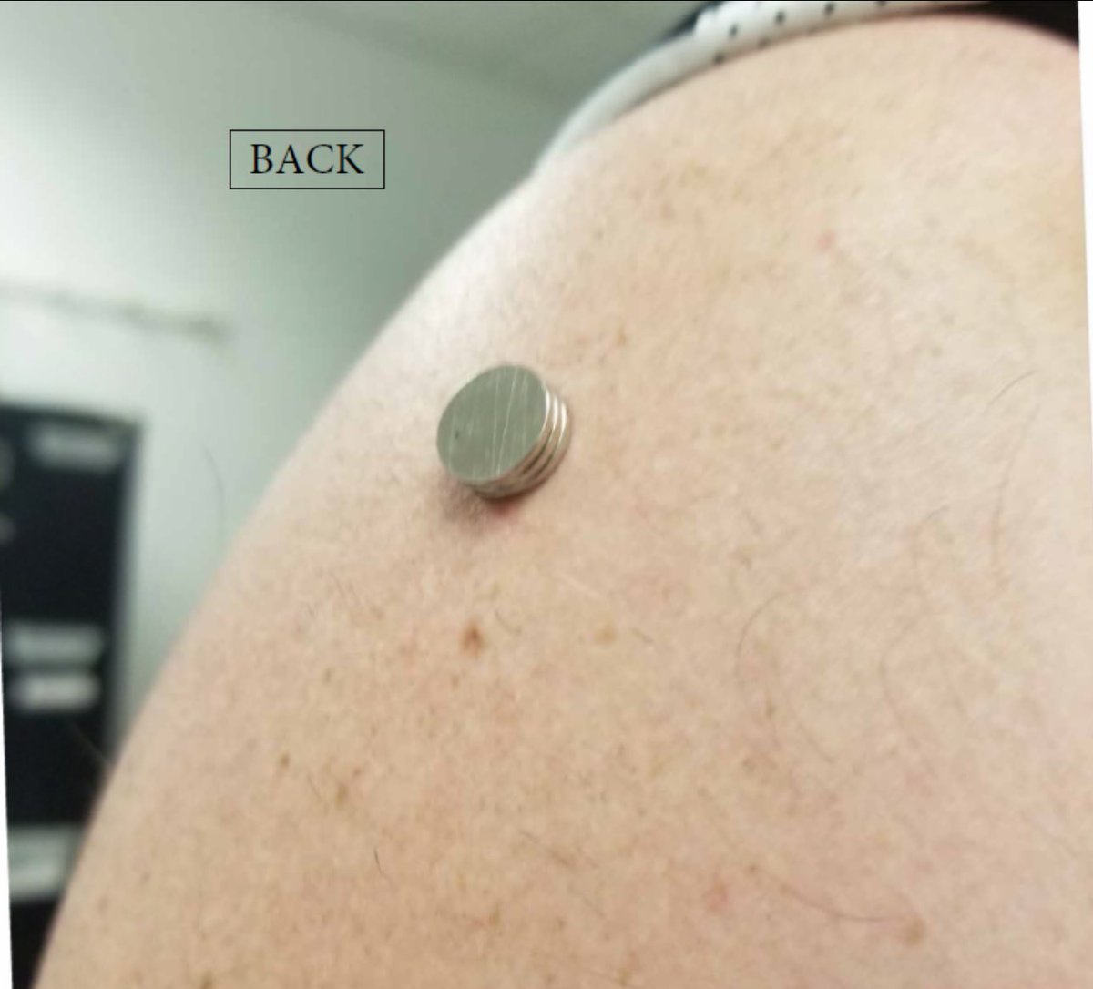 BGatesIsaPyscho's tweet photo. After Covid Vaccination many people conducted the ‘Magnet Test’ in which metal would stick to the injection site area.

So common & well know was the test, that Legacy Media had to try & repeatedly debunk it.

However new study has just confirmed why these tests were true & demonstrated that people turned electromagnetic due to the composition of the experimental vaccine.