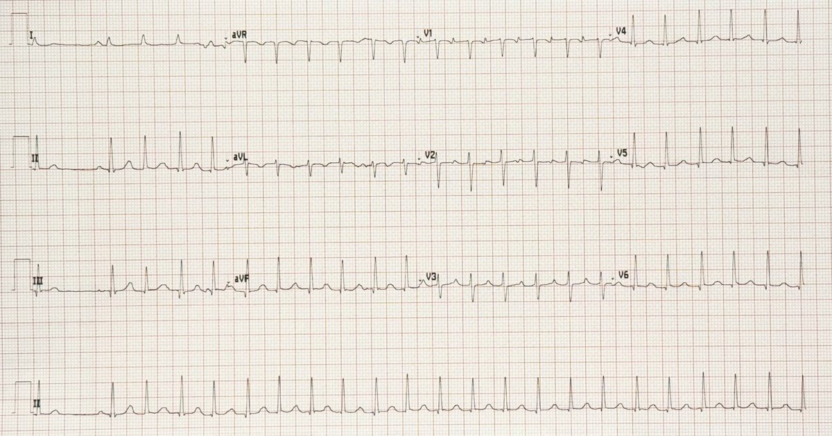 34 years old patient came to the ER with palpitation and chest pain, what do you see?