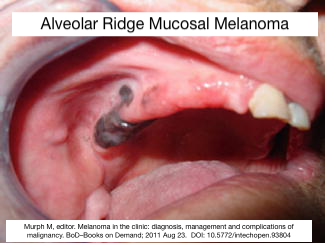 Path4People's tweet image. Melanoma can occur in Mucosal Sites like Rectum, Sinonasal, Vaginal Wall

I always found this interesting because we usually associate it 🦀 with skin ☀️ 

Melanocytes are Neural Crest Derived 👶 and they migrate to the mucosa (as well as skin).  

#pathx #embryology #peds