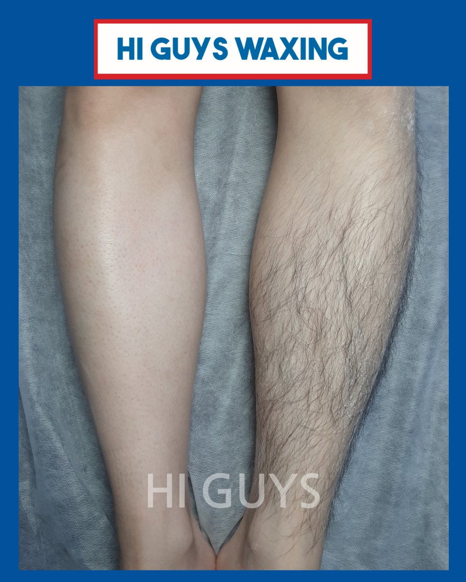 [하이가이즈 왁싱]  
남자 다리왁싱🩵

더워지면서 다리왁싱이 많아 지고 있습니다.
매끈하게 반바지 입어보세요! 

남성전용 왁싱 네이버예약📷 naver.me/GKUxX6OD

 #남자왁서 #남자왁싱 #남성전문왁싱샵 #군자왁싱 #건대왁싱 #하이가이즈왁싱