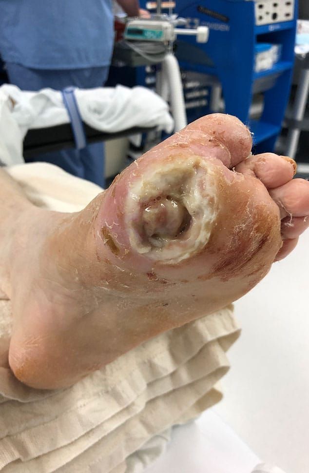 DGArmstrong's tweet image. When There is a Chronic DFU and Complete Dorsal Dislocation of the First and Second MTPJs limbpreservationsociety.org/resources/case…