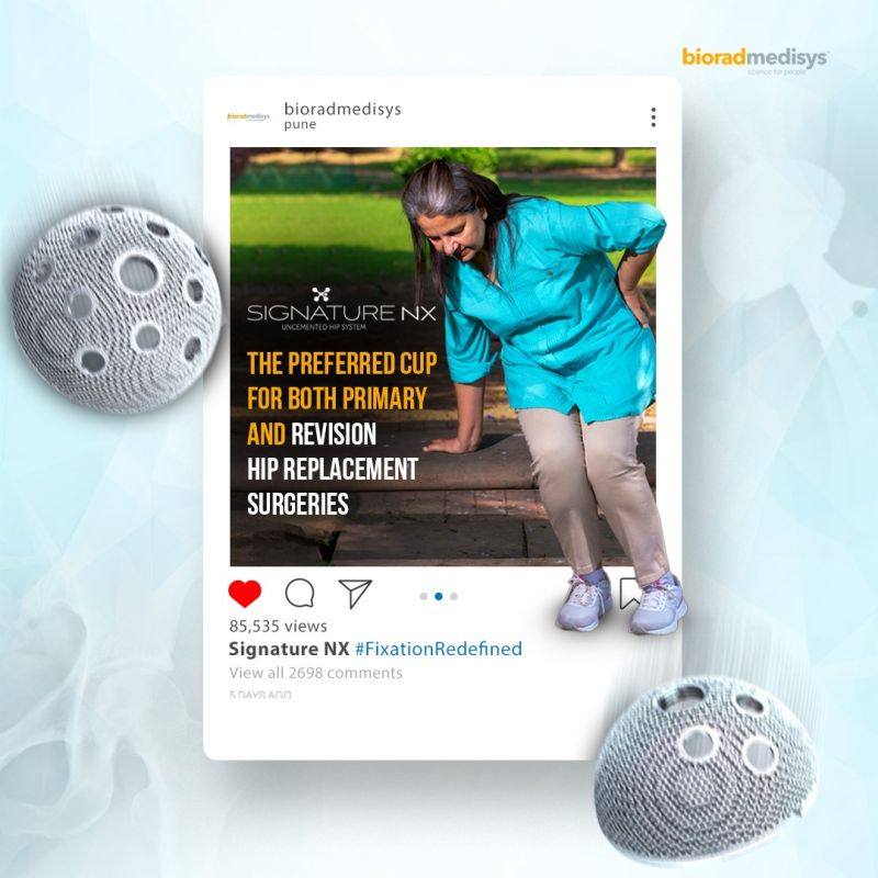 #SignatureNX trabecular acetabular cup stands as the pinnacle choice for both primary and revision #hipreplacement procedures. Engineered to deliver unparalleled stability and an expanded range of motion, it redefines surgical excellence.

#BioradMedisys #orthopedics #trabecular