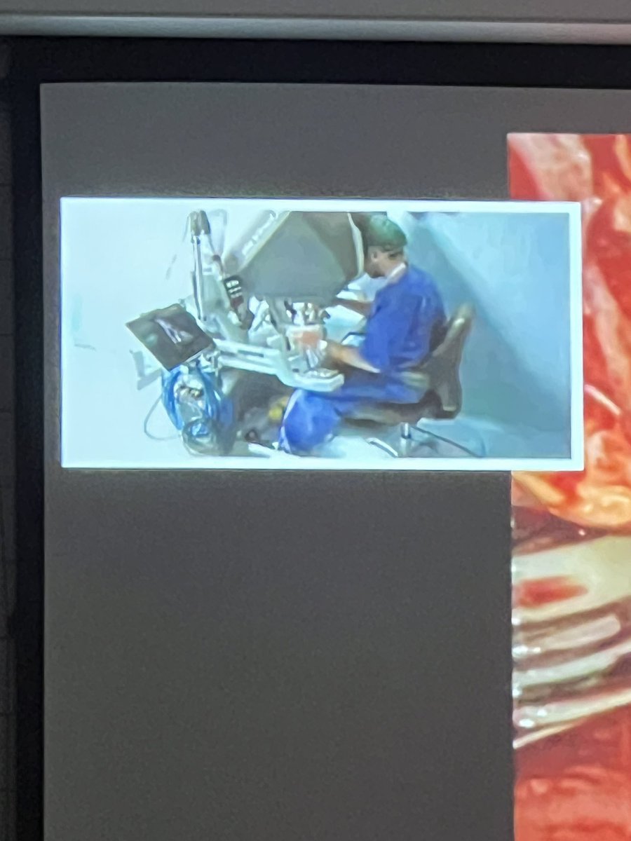 Synergy_Uro's tweet image. 🔴🎥 Live surgery session now at #SynergyCongress — and it’s top-tier!
👨⚕️ At the console: Dr. Matteo Massanova performing a RARC with ileal conduit 🤖🩺
🎙️ Moderated by an outstanding panel: Prof. Minervini, Prof. L. Mertens, Prof. Annino & Prof. Longo 🌍💬