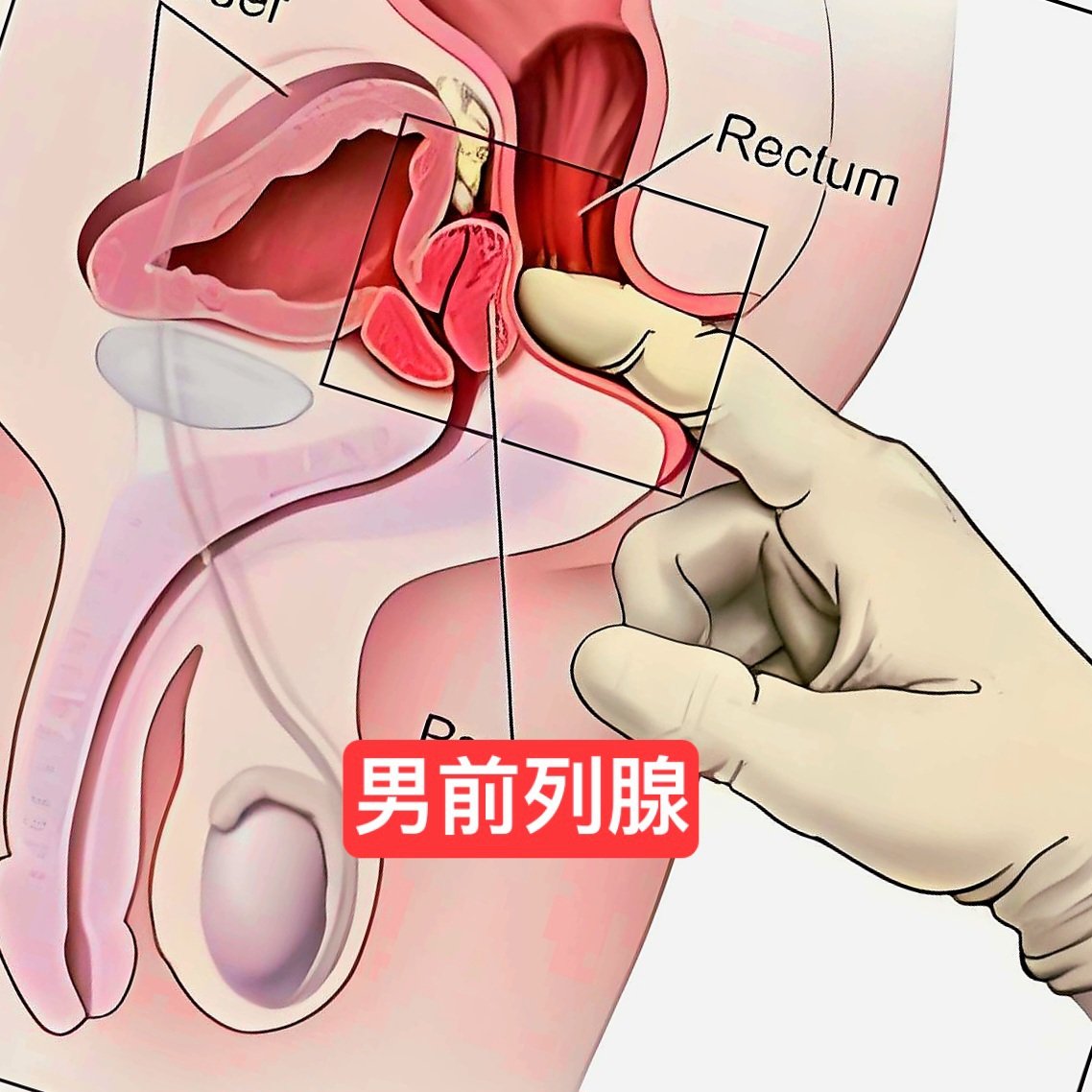 男前列腺和女G点都是同一个位置
惊人相同点:

1:都是3-5cm位置
2:都需要压力才能刺激到
3:触摸手感（女豆粒状，男栗子🌰状）
4:高潮都喷射分泌透明或乳白色液体（女性-射液、男-前列腺液）
5:都是身体中的“终极隐藏式性敏感开关”
6:都是一波接一波多重反复性高潮
7:高潮感都从骨盆深处扩散蔓延至全身