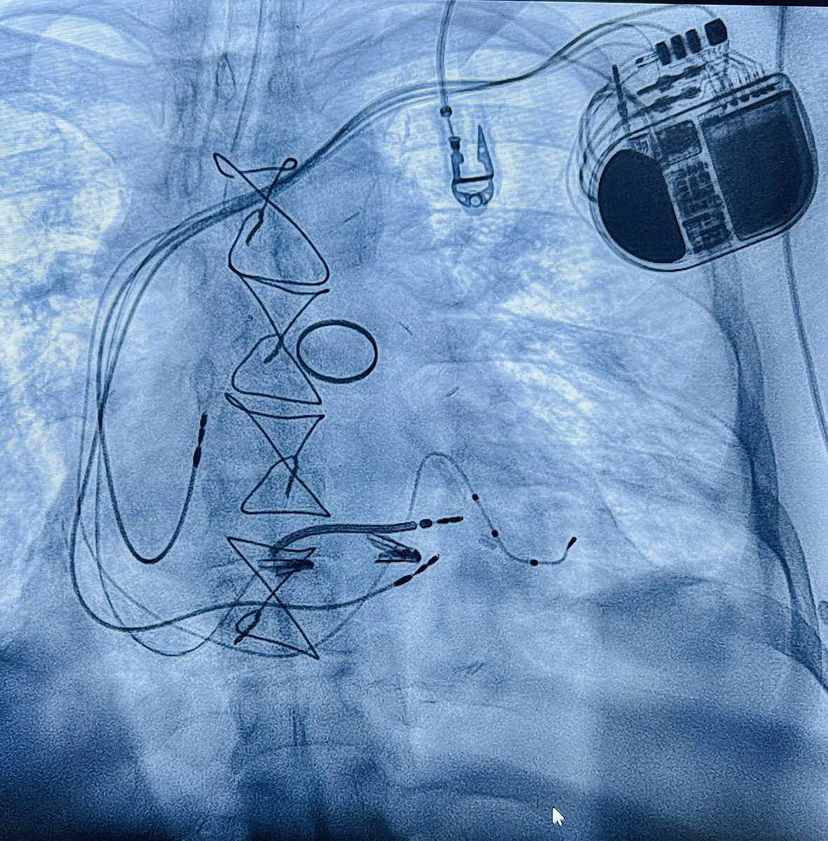 Enes Elvin Gul, MD, FESC, FEHRA (@enes_elvin) on Twitter photo What kind of procedures can you notice on the XRAY? #Epeeps <a href="/alsertdemir/">dr_alsertdemir</a> <a href="/abdullahicli/">Abdullah İçli MD, Professor of Cardiology</a> What kind of procedures can you notice on the XRAY? #Epeeps <a href="/alsertdemir/">dr_alsertdemir</a> <a href="/abdullahicli/">Abdullah İçli MD, Professor of Cardiology</a>