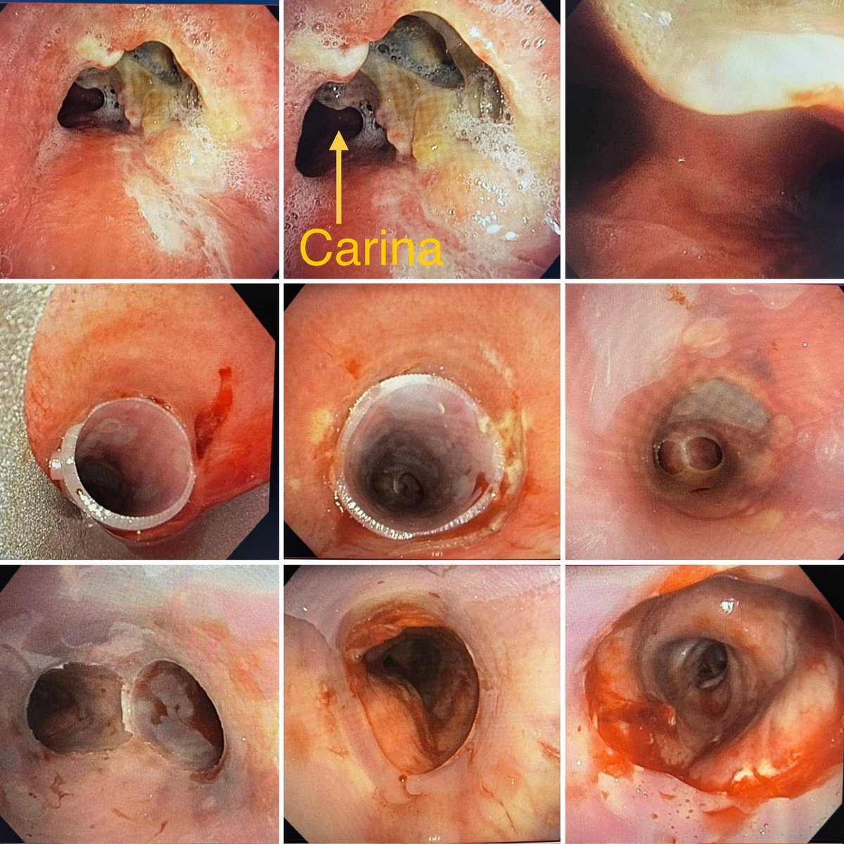 Terrible Things in the Trachea.
Large necrotic anterior tracheal perforation in setting of metastatic cancer and mediastinal SBRT.
Presenting with mediastinitis and not a surgical candidate.
Palliated with silicone tracheal Y-stent.