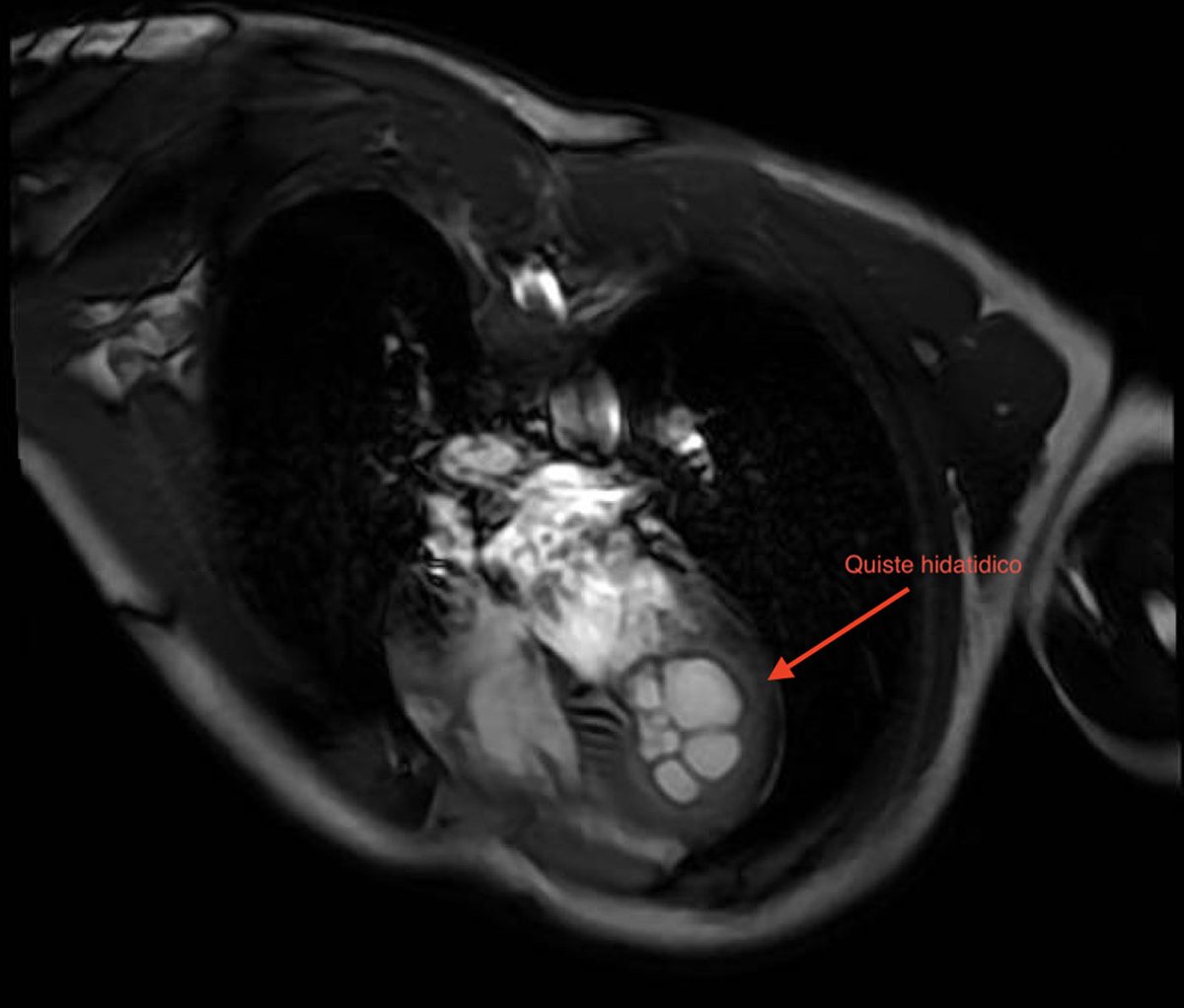 Hidatidosis cardiaca. medintensiva.org/es-hidatidosis…