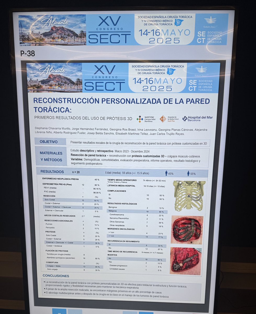 Cirugía Torácica- Hospital de Sant Pau (@toracicasantpau) on Twitter photo Reconstrucción personalizada de la pared torácica mediante tecnología 3D. <a href="/osteobionix/">osteobionix</a> . Experiencia del Servicio Mancomunado de Cirugía Torácica de <a href="/hospitaldelmar/">Hospital del Mar</a> <a href="/HospitalSantPau/">Sant Pau - Campus Salut Barcelona</a>
Trabajo presentado por <a href="/StephaniaChavM/">Stephania Chavarria</a> en el congreso nacional de la SECT Reconstrucción personalizada de la pared torácica mediante tecnología 3D. <a href="/osteobionix/">osteobionix</a> . Experiencia del Servicio Mancomunado de Cirugía Torácica de <a href="/hospitaldelmar/">Hospital del Mar</a> <a href="/HospitalSantPau/">Sant Pau - Campus Salut Barcelona</a>
Trabajo presentado por <a href="/StephaniaChavM/">Stephania Chavarria</a> en el congreso nacional de la SECT