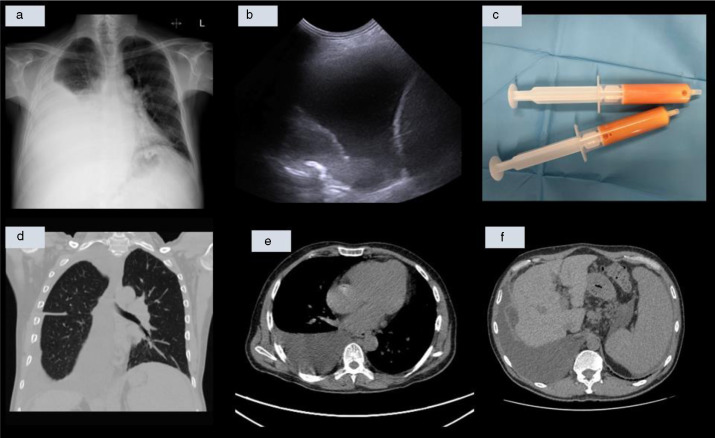 🚨🫁 ¿Sabías que la hipertensión portal puede causar quilotórax, una condición rara que se asocia de manera atípica con la esclerosis sistémica?

🔗 Lee más aquí: n9.cl/z8zdb

#OpenRespiratoryArchives #SEPAR
