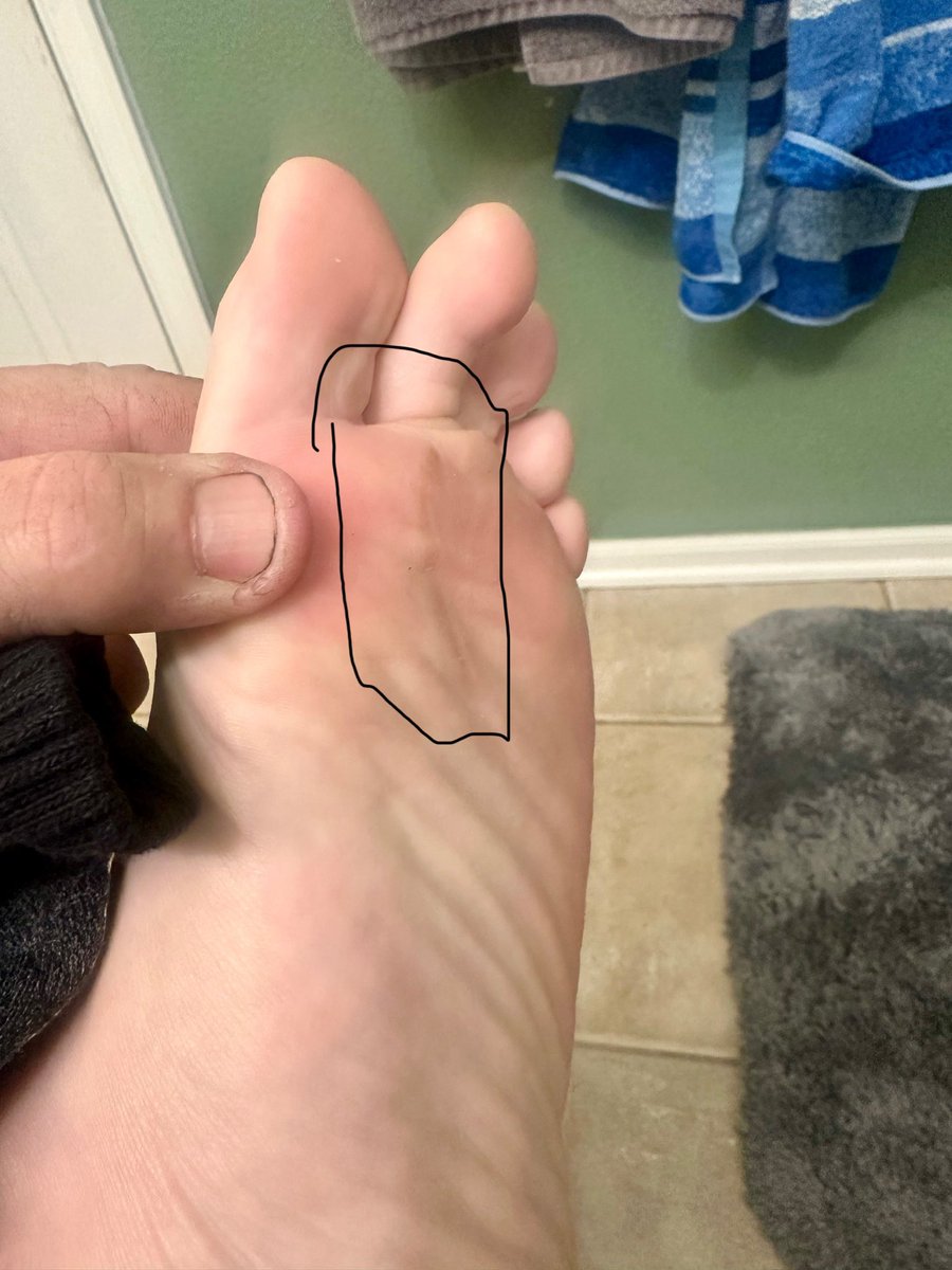 Ken Lesnansky (@klesnansky) on Twitter photo <a href="/VinnieTortorich/">Vinnie Tortorich</a> how do I prevent a cut/blister within the outline while running in hot or wet locations?
Seams to be a straight line. 50k+distances <a href="/VinnieTortorich/">Vinnie Tortorich</a> how do I prevent a cut/blister within the outline while running in hot or wet locations?
Seams to be a straight line. 50k+distances