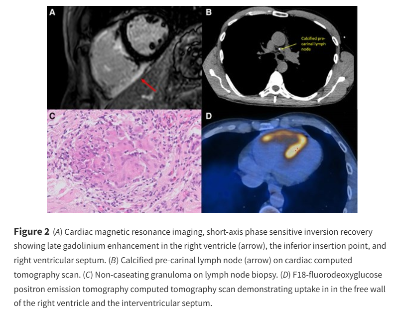 European Society of Cardiology Journals (@esc_journals) on Twitter photo The challenging diagnosis of ARVC - is imaging the key? ow.ly/Nqpk50VSn9a
#EHJCaseReports <a href="/Phiso_de/">Philipp Sommer</a> <a href="/TJ_Yeo/">Tee Joo YEO</a> <a href="/aayshacader/">Aaysha Cader</a> <a href="/BoldiKovacsMD/">Boldizsar Kovacs</a> <a href="/KardiologieHH/">Erik Rafflenbeul</a> <a href="/ANazmiCalik/">A.Nazmi Calik</a> <a href="/O_Azizy_MD/">Obayda Azizy</a> <a href="/saramoscatelli7/">Sara Moscatelli</a> <a href="/EHJCREiC/">EHJCaseReports Editor-in-Chief</a> #CardioX #EPeeps The challenging diagnosis of ARVC - is imaging the key? ow.ly/Nqpk50VSn9a
#EHJCaseReports <a href="/Phiso_de/">Philipp Sommer</a> <a href="/TJ_Yeo/">Tee Joo YEO</a> <a href="/aayshacader/">Aaysha Cader</a> <a href="/BoldiKovacsMD/">Boldizsar Kovacs</a> <a href="/KardiologieHH/">Erik Rafflenbeul</a> <a href="/ANazmiCalik/">A.Nazmi Calik</a> <a href="/O_Azizy_MD/">Obayda Azizy</a> <a href="/saramoscatelli7/">Sara Moscatelli</a> <a href="/EHJCREiC/">EHJCaseReports Editor-in-Chief</a> #CardioX #EPeeps