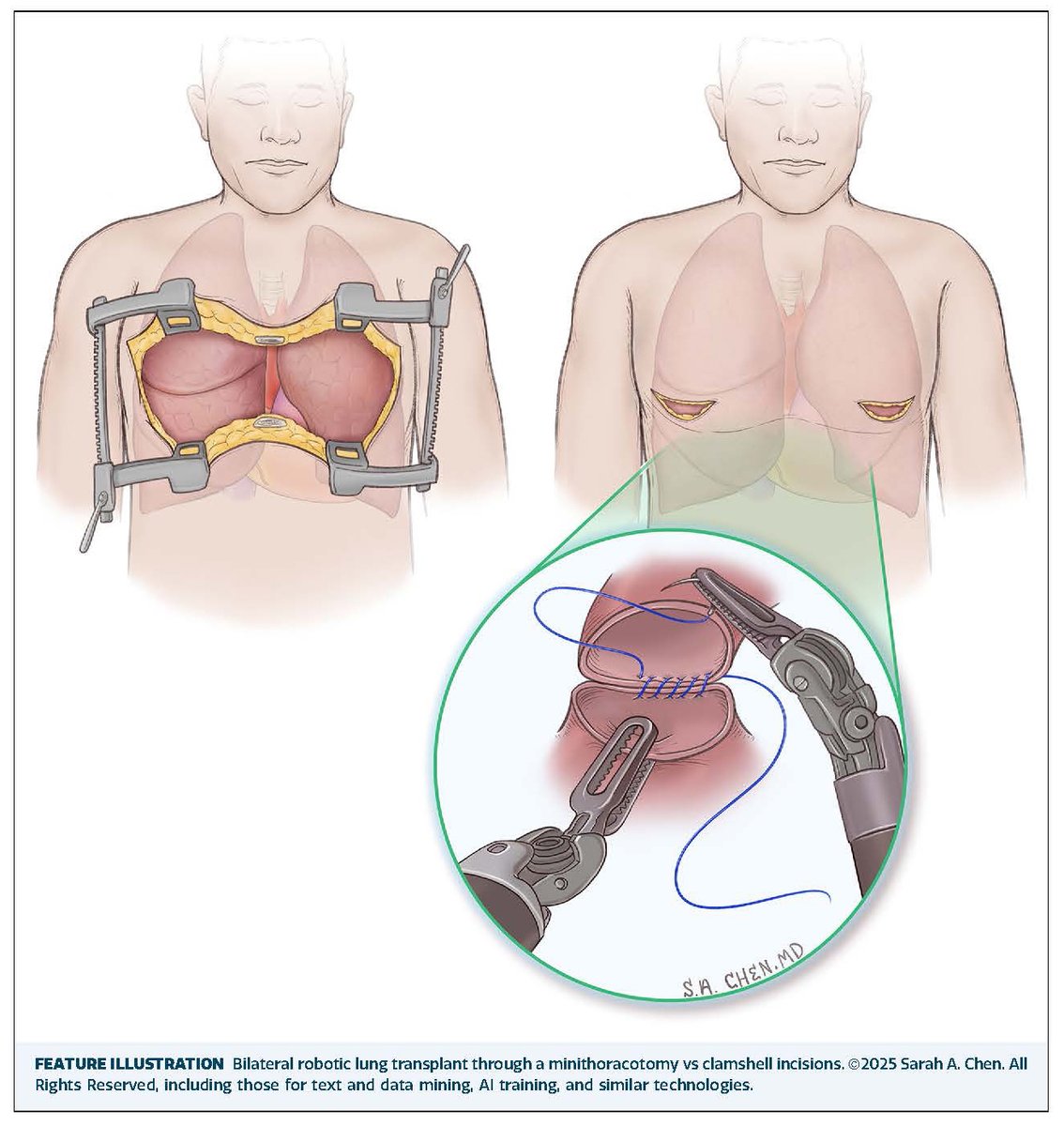 The Annals of Thoracic Surgery (@annalsthorsurg) on Twitter photo #EditorsChoice Robotic Lung Transplantation: Feasibility, Initial Experience, and 3-Year Outcomes from <a href="/DEmersonMD/">Dominic Emerson, MD</a>, <a href="/pacman8it/">Pedro Catarino</a>, and coauthors👇
doi.org/10.1016/j.atho…
<a href="/dichiacchioMD/">Laura DiChiacchio, MD, PhD</a> <a href="/JadMalasMD/">Jad Malas</a> <a href="/JoChikweMD/">Jo Chikwe</a> #EditorsChoice Robotic Lung Transplantation: Feasibility, Initial Experience, and 3-Year Outcomes from <a href="/DEmersonMD/">Dominic Emerson, MD</a>, <a href="/pacman8it/">Pedro Catarino</a>, and coauthors👇
doi.org/10.1016/j.atho…
<a href="/dichiacchioMD/">Laura DiChiacchio, MD, PhD</a> <a href="/JadMalasMD/">Jad Malas</a> <a href="/JoChikweMD/">Jo Chikwe</a>