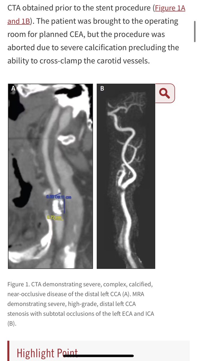 Eli EK MD (@thesurgerylife) on Twitter photo <a href="/EVToday/">Endovascular Today</a> a vascular surgeon took the patient to the OR and could not cross clamp the vessels below because theyre calcified? theres plenty of room to clamp based on this ct? (Again nothing against tcar or tf-CAS, i do cea, tcar and tf-cas..) this is to segway from <a href="/farkomd/">frank arko</a> post <a href="/EVToday/">Endovascular Today</a> a vascular surgeon took the patient to the OR and could not cross clamp the vessels below because theyre calcified? theres plenty of room to clamp based on this ct? (Again nothing against tcar or tf-CAS, i do cea, tcar and tf-cas..) this is to segway from <a href="/farkomd/">frank arko</a> post