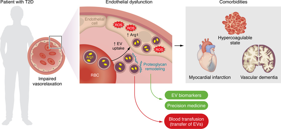 Francesco Paneni (@francescopaneni) on Twitter photo Red blood cells drive endothelial dysfunction in #diabetes! Read our article in <a href="/jclinicalinvest/">Journal of Clinical Investigation</a> where we discuss the recent findings from the #PernowLab:
jci.org/articles/view/…
<a href="/CTECresearch/">CTEC - Zurich University Heart Center</a> #SarahCostantino <a href="/shafeeq_moham/">Shafeeq mohammed</a> <a href="/GoricaEra/">Era Gorica</a> Red blood cells drive endothelial dysfunction in #diabetes! Read our article in <a href="/jclinicalinvest/">Journal of Clinical Investigation</a> where we discuss the recent findings from the #PernowLab:
jci.org/articles/view/…
<a href="/CTECresearch/">CTEC - Zurich University Heart Center</a> #SarahCostantino <a href="/shafeeq_moham/">Shafeeq mohammed</a> <a href="/GoricaEra/">Era Gorica</a>