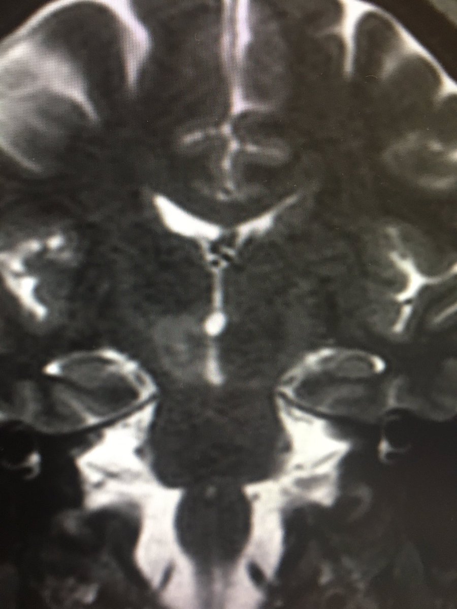 Can cannabis induce this lesion? He , 29 year old presented with left hemiparesia .Constant use of cannabis for 15 years