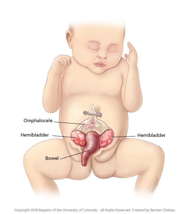 How do we determine if a patient with Cloacal Exstrophy is a candidate for a stoma pullthrough? 

During the newborn period, all colon (hindgut) is incorporated into the gastrointestinal tract as an end colostomy. Around 3 years of age: 🧵