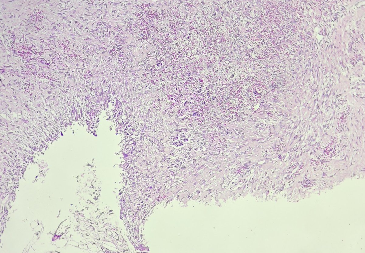 pathphyo's tweet photo. A nice example of sister Mary Joseph nodule presenting as an umbilical nodule composed of irregular clusters of adenocarcinoma and signet ring cells. The patient has gastric carcinoma with secondaries in omentum, and right ovary also .#pathology #GIPath #signets https://t.co/XIrxzYJs7o