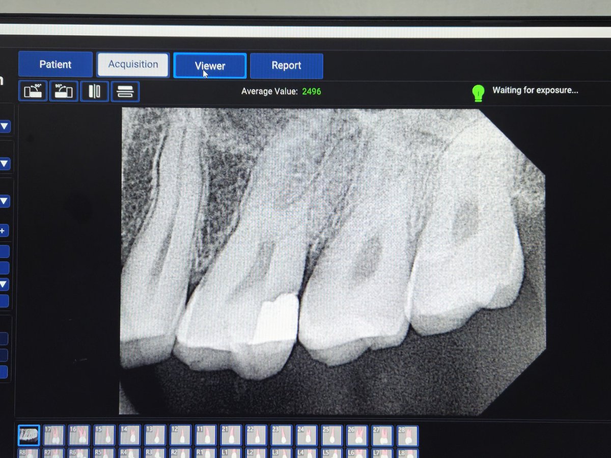 itssunilbehera's tweet image. Tweet 8/8
Visited a nearby dental clinic for pain after filling at @KIMSBBSR. Doctor said I need RCT—KIMS wrongly filled my teeth, causing persistent pain. Why does KIMS keep doing this? Why are students allowed to do fillings without proper checks? #KIMSHospital #PatientSafety