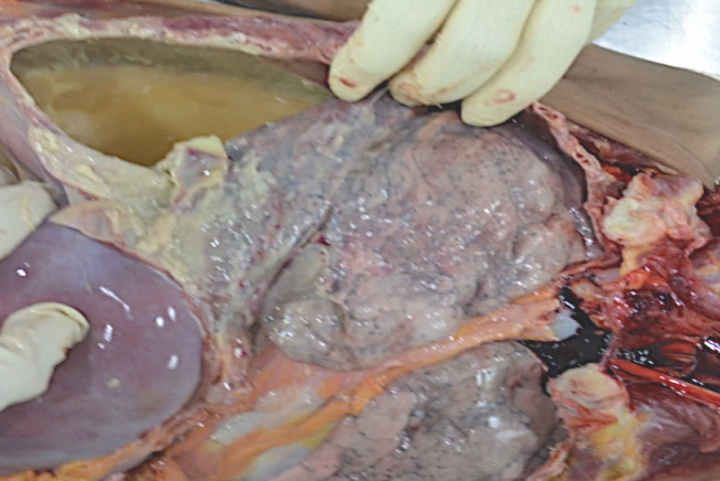 Case of the Week: 46yo homeless woman w/ hx of chronic smoking found dead after weeks of chest pain w/o respiratory symptoms. See the autopsy findings below and click the link for the full question stem!
tinyurl.com/3spz5rx7
