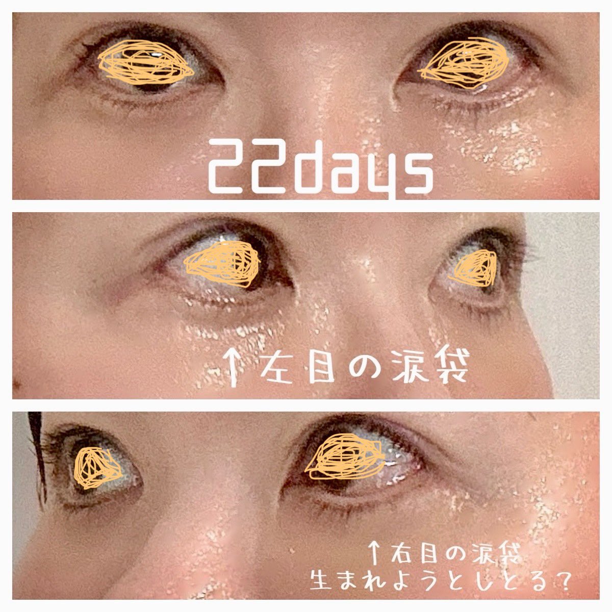 表ハムラ➕ミッドフェイスリフト➕ナノリッチ➕埋没22日目

👀3週間たって涙袋(👉)がうっすら！うっすら生まれてきた！はよ！

😣拘縮は頬骨の上あたりにまだある感じ。変顔すると引っ張られる感じがするし、表情はまだキモイ。でも少しマシになってきたよ。毎日ホットアイマスクしてる。