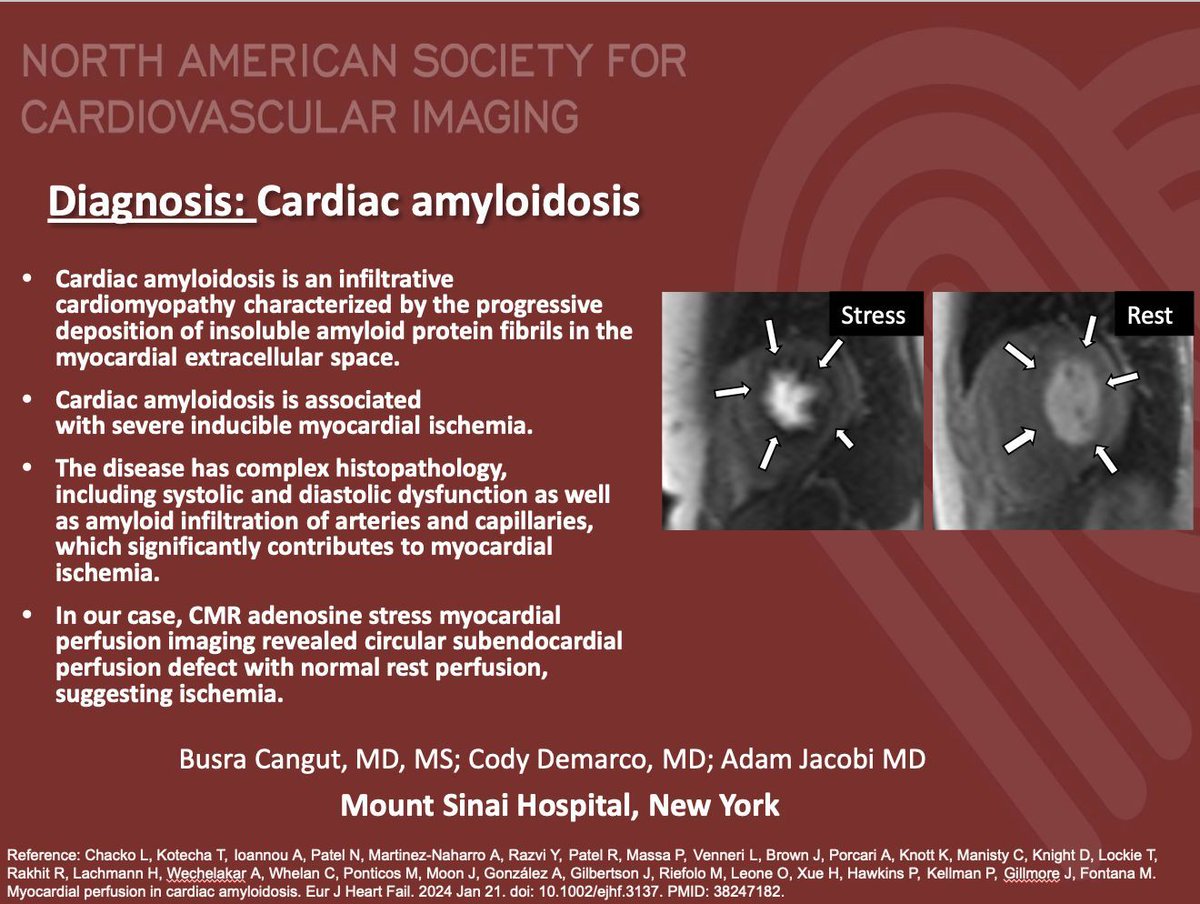 NASCI (@nascisociety) on Twitter photo #NASCI Case Series
Case 77 Diagnosis
Courtesy of Busra Cangut <a href="/BusraCangutMD/">Busra Cangut, MD, MS</a> from Mount Sinai Hospital, New York
#whyCMR #YesCCT
<a href="/GregKicska/">Gregory Kicska</a> <a href="/JRevRad1/">Jonathan Revels DO, FSAR</a> <a href="/dianalitmano/">diana litmanovich</a> <a href="/DanielVargasMD/">Daniel Vargas, MD</a> <a href="/kirschj/">Jacobo Kirsch, MD, MBA, FACR</a> <a href="/prachipagarwal/">Prachi Agarwal</a> <a href="/AwsHamid5/">Aws Hamid, MD, MS</a> <a href="/EscrOffice/">ESCR Vienna</a> <a href="/CarlottaOnnis/">Carlotta Onnis</a> <a href="/DeCeccoCN/">Carlo N. De Cecco, MD, PhD</a> #NASCI Case Series
Case 77 Diagnosis
Courtesy of Busra Cangut <a href="/BusraCangutMD/">Busra Cangut, MD, MS</a> from Mount Sinai Hospital, New York
#whyCMR #YesCCT
<a href="/GregKicska/">Gregory Kicska</a> <a href="/JRevRad1/">Jonathan Revels DO, FSAR</a> <a href="/dianalitmano/">diana litmanovich</a> <a href="/DanielVargasMD/">Daniel Vargas, MD</a> <a href="/kirschj/">Jacobo Kirsch, MD, MBA, FACR</a> <a href="/prachipagarwal/">Prachi Agarwal</a> <a href="/AwsHamid5/">Aws Hamid, MD, MS</a> <a href="/EscrOffice/">ESCR Vienna</a> <a href="/CarlottaOnnis/">Carlotta Onnis</a> <a href="/DeCeccoCN/">Carlo N. De Cecco, MD, PhD</a>