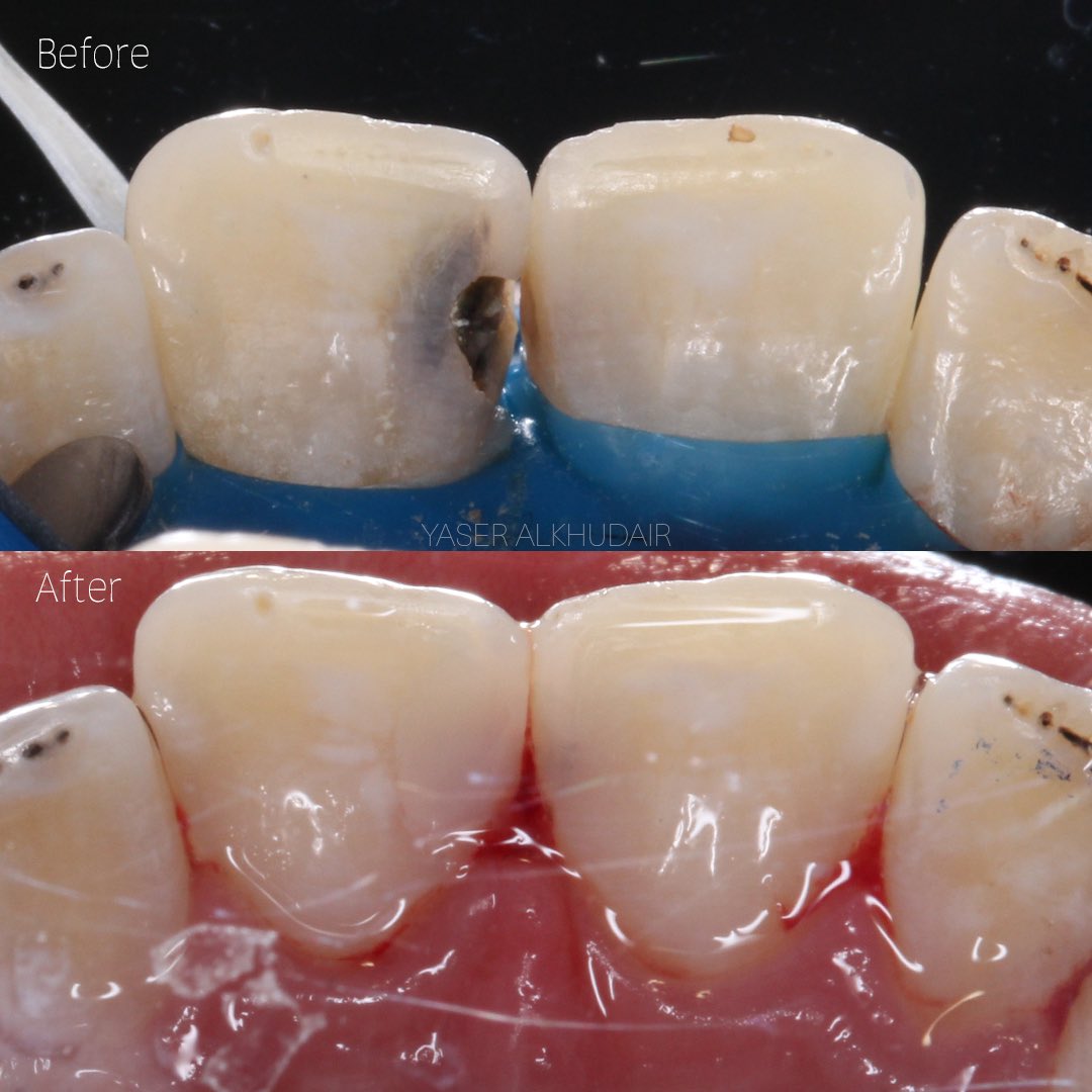 imyvsr's tweet photo. Tooth #11 
Class III restoration ✨ https://t.co/8pXeAP1Pt2