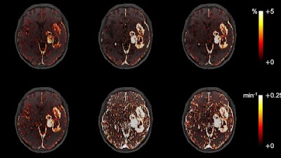 Radiology: Artificial Intelligence (@radiology_ai) on Twitter photo Unsupervised learning framework detects blood-brain barrier leakage in diffuse #glioma without pharmacokinetic models and arterial input function doi.org/10.1148/ryai.2… <a href="/SNU_Rad/">SNU Radiology</a> #MRI #brain #AI Unsupervised learning framework detects blood-brain barrier leakage in diffuse #glioma without pharmacokinetic models and arterial input function doi.org/10.1148/ryai.2… <a href="/SNU_Rad/">SNU Radiology</a> #MRI #brain #AI