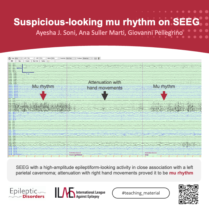 Epileptic Disorders (@epidisorders) on Twitter photo 🧐 Wondering what the mu rhythm is looking like on sEEG? Here is a good example!
Check the article here: onlinelibrary.wiley.com/doi/10.1002/ep…
<a href="/AnphyLab/">The AnPhy Lab</a> <a href="/giocastellucci/">Giovanni Castellucci, MD, MS</a>
<a href="/GiovanniFa83566/">Giovanni Falcicchio</a> <a href="/SBeniczky/">Sandor Beniczky</a> <a href="/SheikhISMD/">irfan sheikh 伊凡</a> <a href="/joanajribeiro/">Joana Ribeiro</a> <a href="/AlinaIvaniuk/">Alina Ivaniuk 🇺🇦</a> <a href="/ana_suller/">Ana suller</a> 🧐 Wondering what the mu rhythm is looking like on sEEG? Here is a good example!
Check the article here: onlinelibrary.wiley.com/doi/10.1002/ep…
<a href="/AnphyLab/">The AnPhy Lab</a> <a href="/giocastellucci/">Giovanni Castellucci, MD, MS</a>
<a href="/GiovanniFa83566/">Giovanni Falcicchio</a> <a href="/SBeniczky/">Sandor Beniczky</a> <a href="/SheikhISMD/">irfan sheikh 伊凡</a> <a href="/joanajribeiro/">Joana Ribeiro</a> <a href="/AlinaIvaniuk/">Alina Ivaniuk 🇺🇦</a> <a href="/ana_suller/">Ana suller</a>