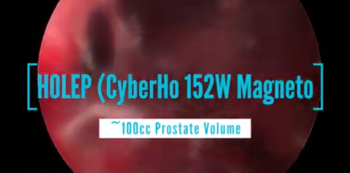 Karl Tan, MD (Endouro) 🇵🇭 (@iamdockarl) on Twitter photo "MAGLEP"
~100cc prostate volume with bleeding and post TURP changes referred for AEEP.
Love the control of bleeders using #MAGNETO
<a href="/DocGauhar/">DrG</a> <a href="/Mohamedendourol/">Mohamed_omar</a> <a href="/kmoretry/">Sung Yong CHO</a> <a href="/LoKaLun1/">Lo Ka Lun</a> <a href="/quanta_system/">Quanta Surgery</a> <a href="/LucaMartinel/">luca martinelli</a> <a href="/fgomsan/">Fernando GomezSancha</a> <a href="/FCAFigueiredo/">Felipe Figueiredo HoLEP 🇧🇷</a> <a href="/scoffonecesare/">scoffone cesare</a> <a href="/trwherrmann/">Thomas RW Herrmann</a> "MAGLEP"
~100cc prostate volume with bleeding and post TURP changes referred for AEEP.
Love the control of bleeders using #MAGNETO
<a href="/DocGauhar/">DrG</a> <a href="/Mohamedendourol/">Mohamed_omar</a> <a href="/kmoretry/">Sung Yong CHO</a> <a href="/LoKaLun1/">Lo Ka Lun</a> <a href="/quanta_system/">Quanta Surgery</a> <a href="/LucaMartinel/">luca martinelli</a> <a href="/fgomsan/">Fernando GomezSancha</a> <a href="/FCAFigueiredo/">Felipe Figueiredo HoLEP 🇧🇷</a> <a href="/scoffonecesare/">scoffone cesare</a> <a href="/trwherrmann/">Thomas RW Herrmann</a>
