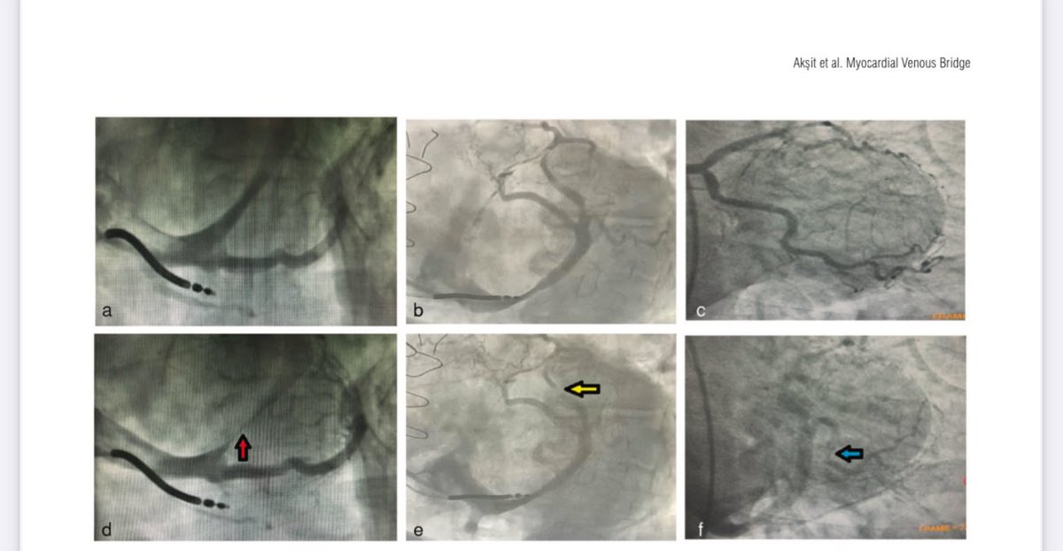 Ercan Akşit (@er_cordis) on Twitter photo This new phenomenon may change our treatment approach in some cases of MB <a href="/TKDResmi/">Türk Kardiyoloji Derneği</a> <a href="/escardio/">European Society of Cardiology</a> <a href="/sumitvermaep/">Sumit Verma</a> <a href="/balkanmedj/">Balkan Medical Journal</a> <a href="/onsekizmartuni/">ÇOMÜ</a> <a href="/ACCinTouch/">American College of Cardiology</a> This new phenomenon may change our treatment approach in some cases of MB <a href="/TKDResmi/">Türk Kardiyoloji Derneği</a> <a href="/escardio/">European Society of Cardiology</a> <a href="/sumitvermaep/">Sumit Verma</a> <a href="/balkanmedj/">Balkan Medical Journal</a> <a href="/onsekizmartuni/">ÇOMÜ</a> <a href="/ACCinTouch/">American College of Cardiology</a>