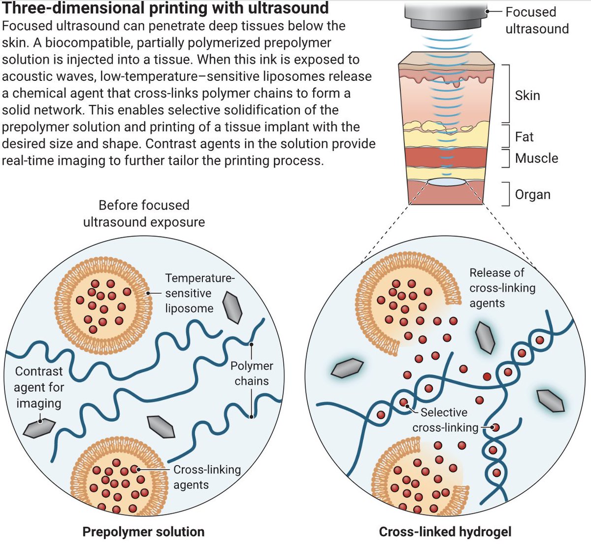 Lasker Foundation (@laskerfdn) on Twitter photo A study by <a href="/DavoodiElham/">Elham (Emma) Davoodi</a> presents a novel imaging-guided in-vivo 3D printing platform that enables noninvasive deposition of biomaterials via focused ultrasound. This deep-tissue printing could have applications in drug delivery and tissue repair. science.org/doi/10.1126/sc… A study by <a href="/DavoodiElham/">Elham (Emma) Davoodi</a> presents a novel imaging-guided in-vivo 3D printing platform that enables noninvasive deposition of biomaterials via focused ultrasound. This deep-tissue printing could have applications in drug delivery and tissue repair. science.org/doi/10.1126/sc…