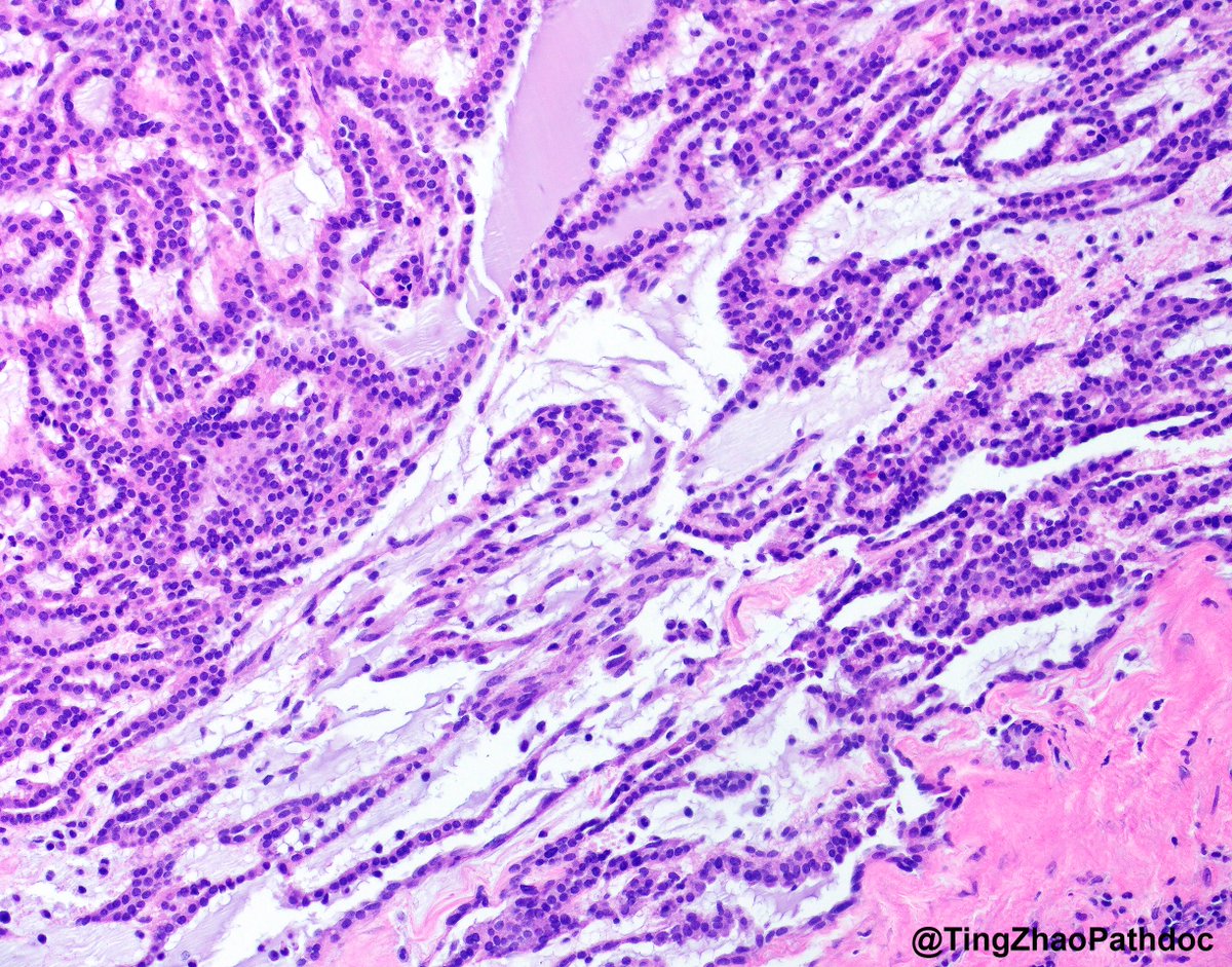 Ting Zhao, MD (@tingzhaopathdoc) on Twitter photo A 3.2 cm renal mass was incidentally discovered during the evaluation for bilateral kidney and liver donation. What is your diagnosis?
#PathTwitter
<a href="/RepettoF_MD/">Federico Repetto, MD</a> <a href="/MGBpathology/">Mass General Brigham Pathology</a> <a href="/MGHPathology/">MGH Pathology</a> A 3.2 cm renal mass was incidentally discovered during the evaluation for bilateral kidney and liver donation. What is your diagnosis?
#PathTwitter
<a href="/RepettoF_MD/">Federico Repetto, MD</a> <a href="/MGBpathology/">Mass General Brigham Pathology</a> <a href="/MGHPathology/">MGH Pathology</a>